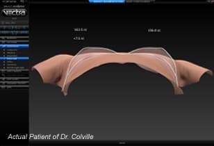 Vectra 3D Imaging example