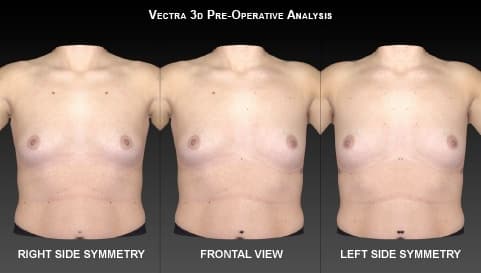 Calculation of pre-operative breast weight using Vectra XT 3D Face and