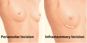Breast Augmentation incisions