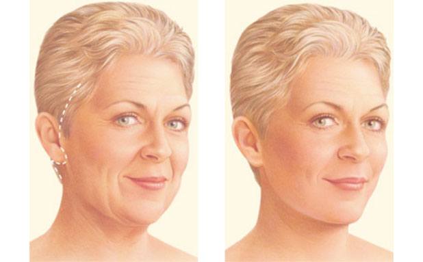 Facelift incision options