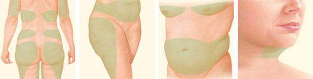 Liposuction areas