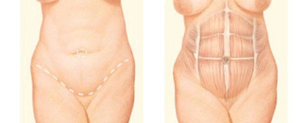 Tummy Tuck incisions