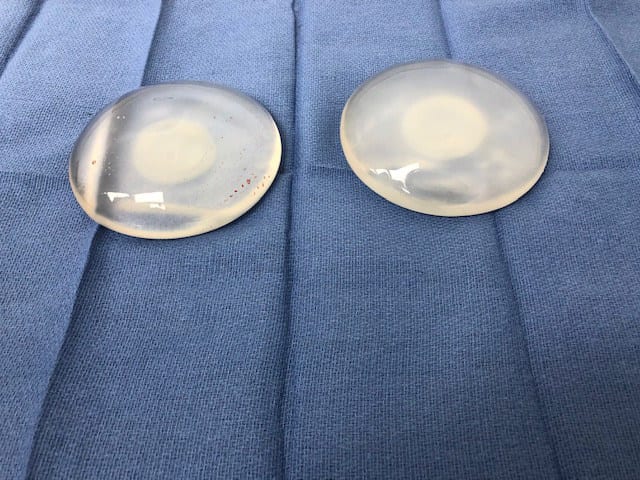Silicone gel breast implants