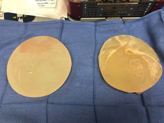 Textured breast implants removed from a patient