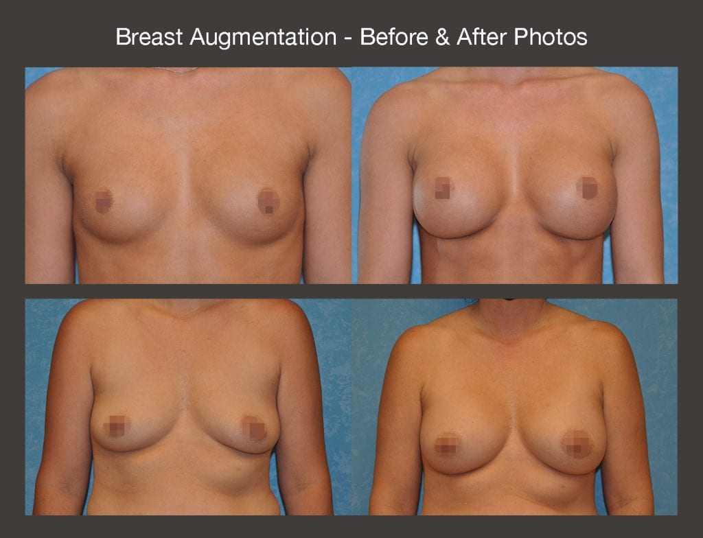 Breast Augmentation before-and-after image, from two Toledo patients.