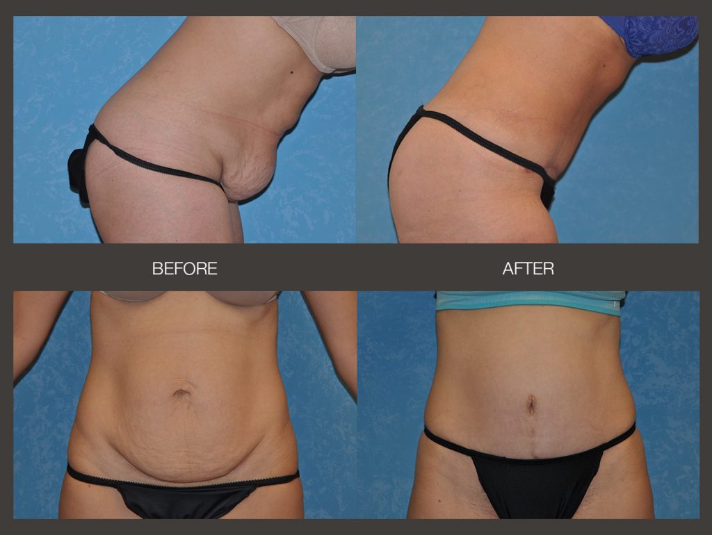 tummy tuck patients, before and after photos