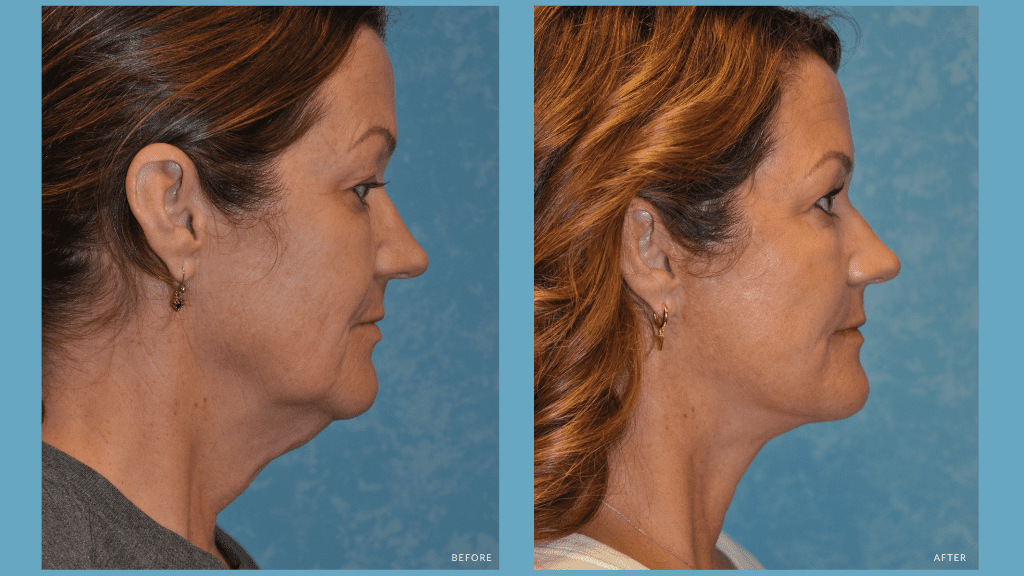 Facelift Before and After