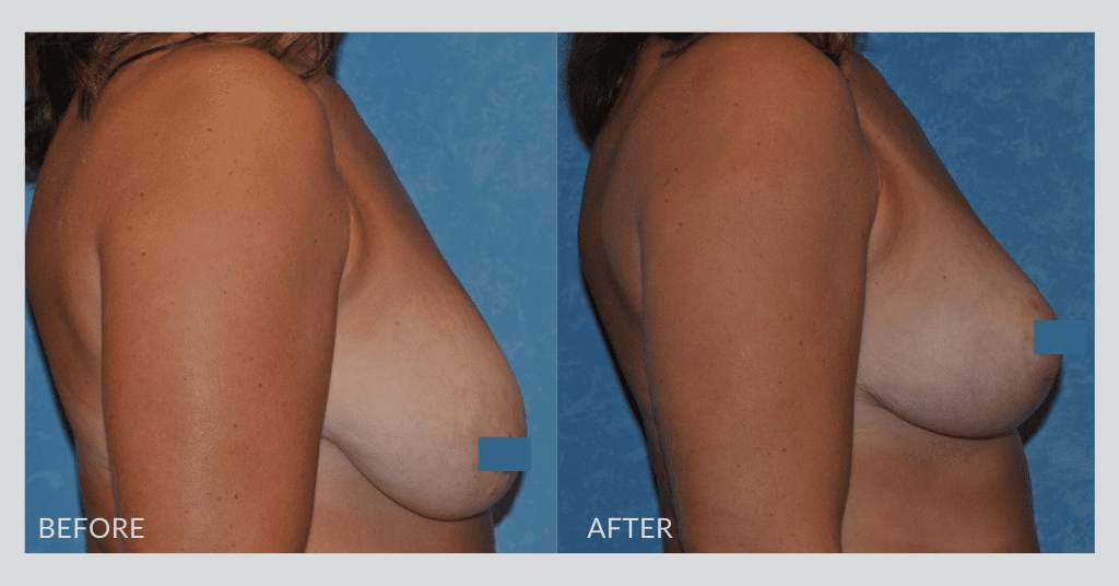Breast Lift by Dr. Colville - Before and After