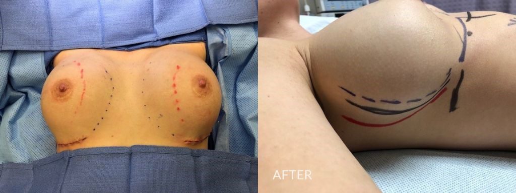 implant malposition