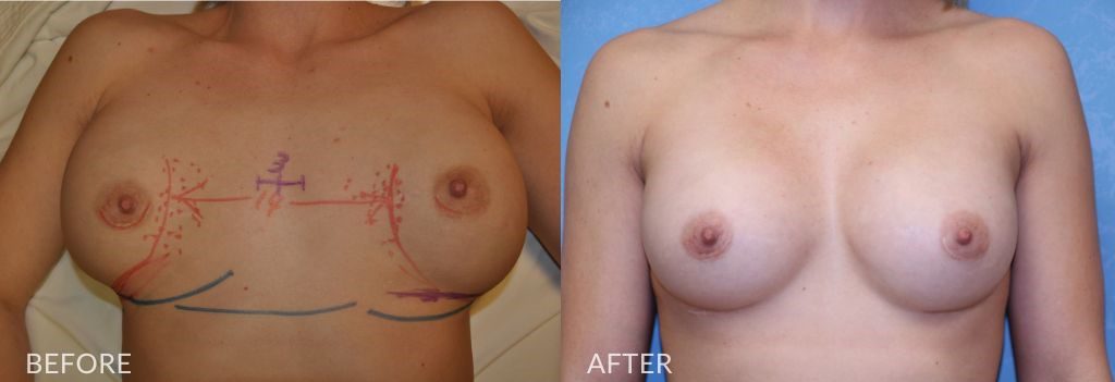 before and after implant malposition